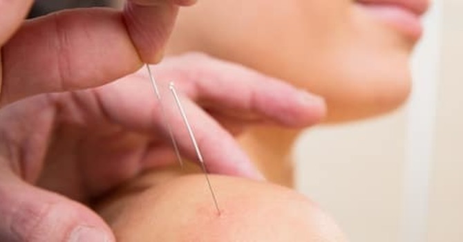 Acupuncture